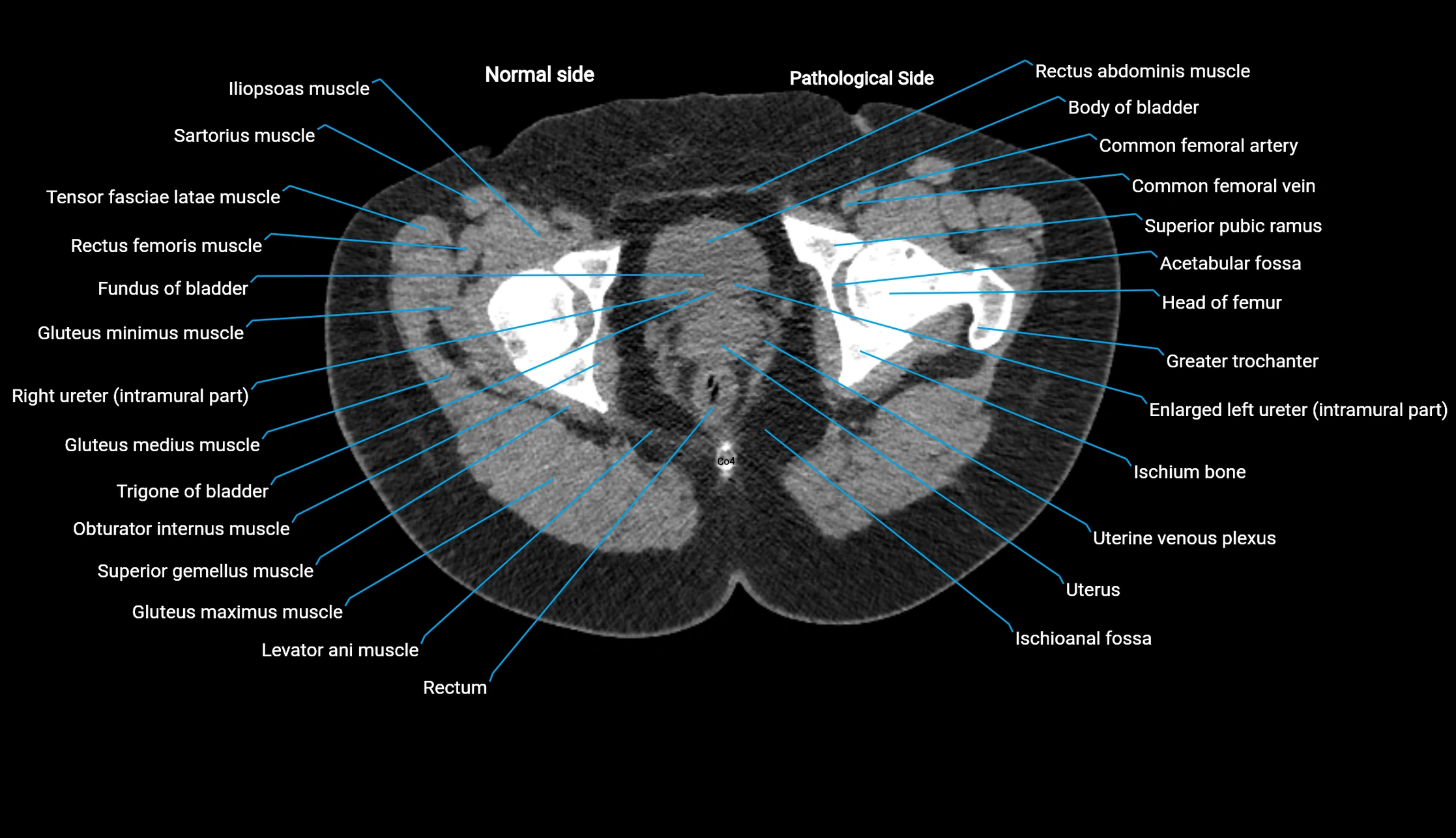 CT KUB axial cross sectional anatomy  radiology image -img-00201-00162.webp